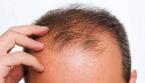 کاشت مو بدون جراحی چگونه است؟