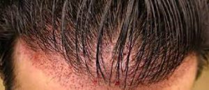 کاشت مو بدون جراحی چیست