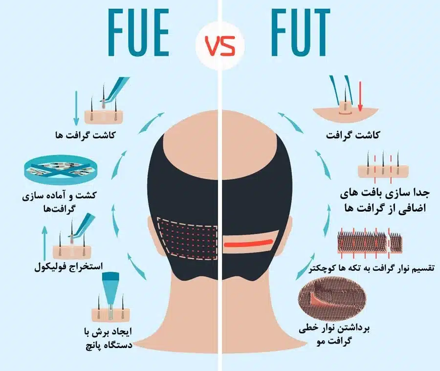 کلینیک گلچهره کاشت مو
