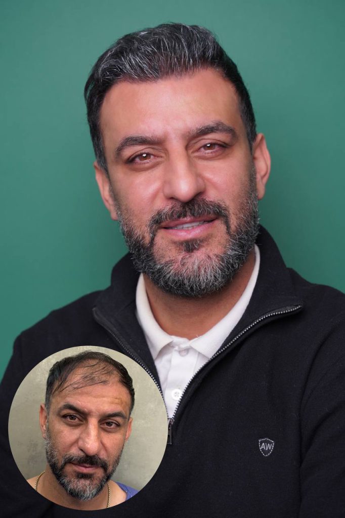 Hair transplant