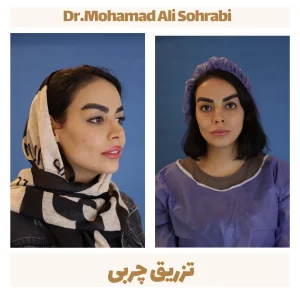 تزریق چربی