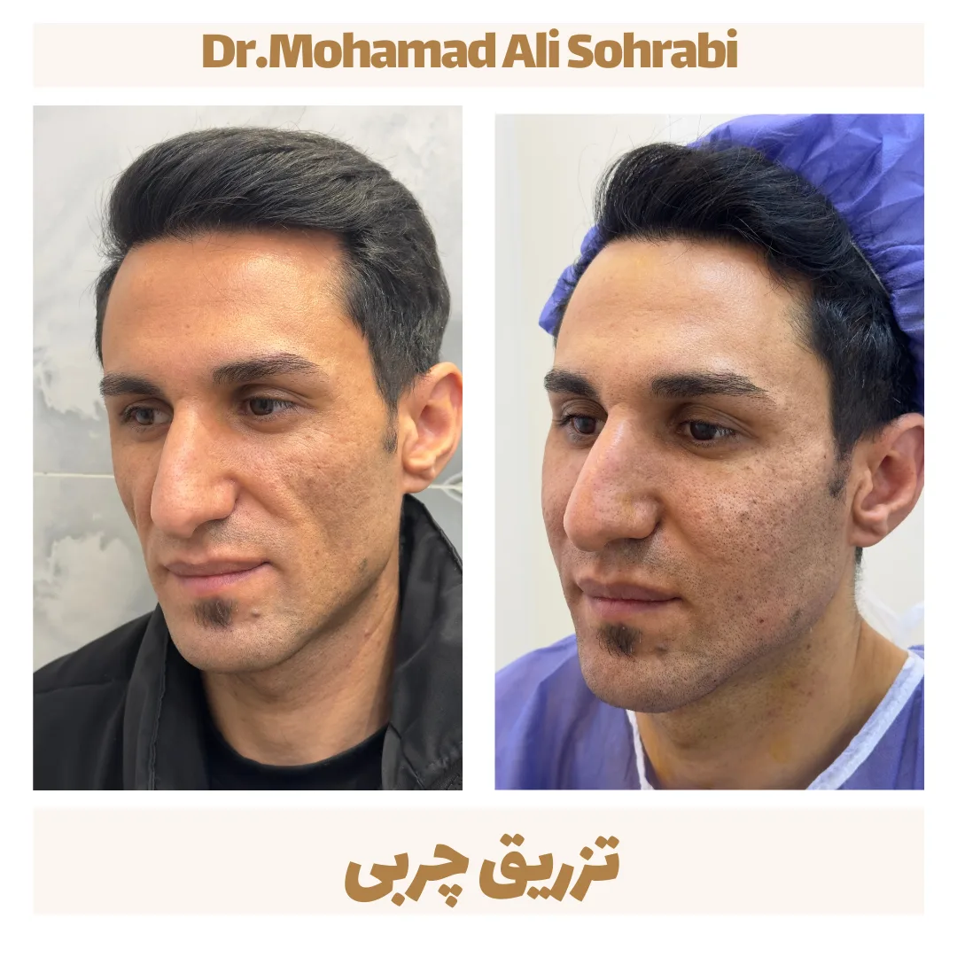 تزریق چربی