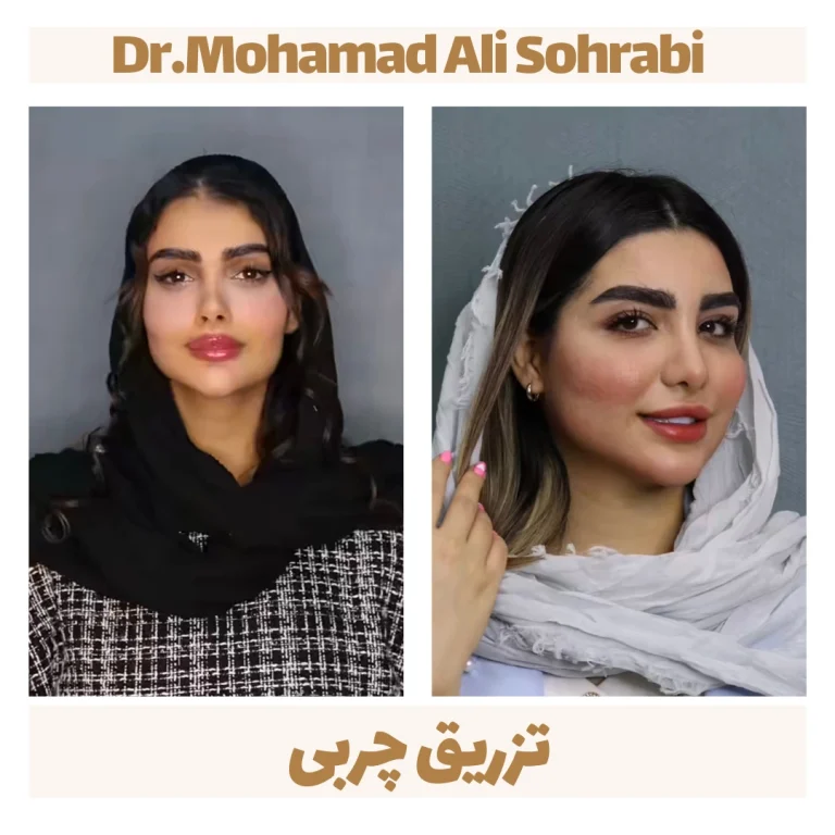 تزریق چربی
