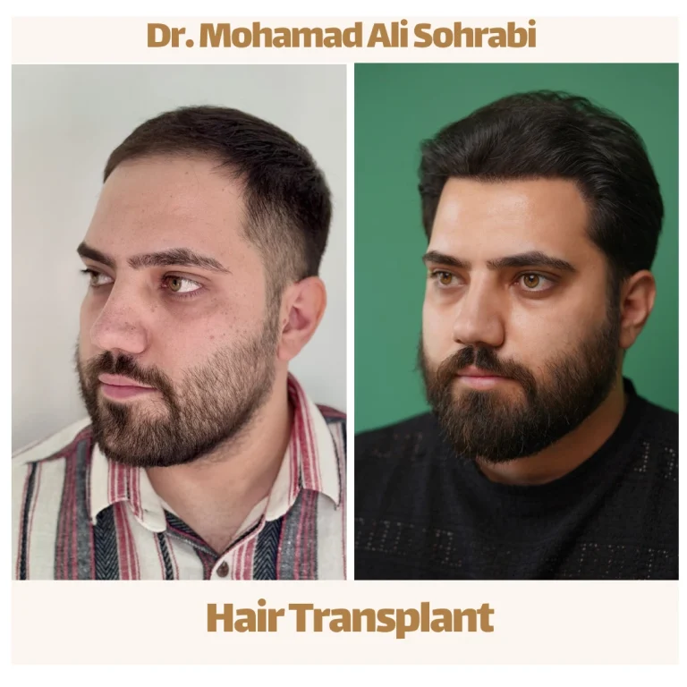 High density hair transplant result