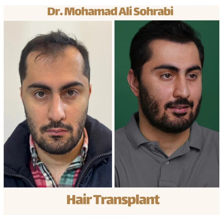 أفضل طريقة لزراعة الشعر