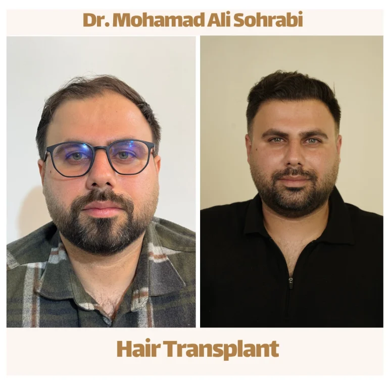 أفضل طريقة لزراعة الشعر
