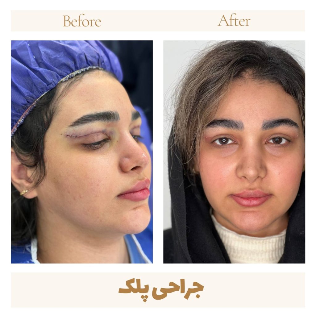 Eyelid surgery