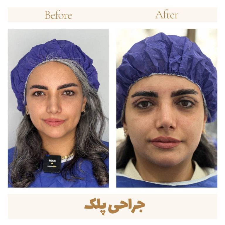Eyelid surgery