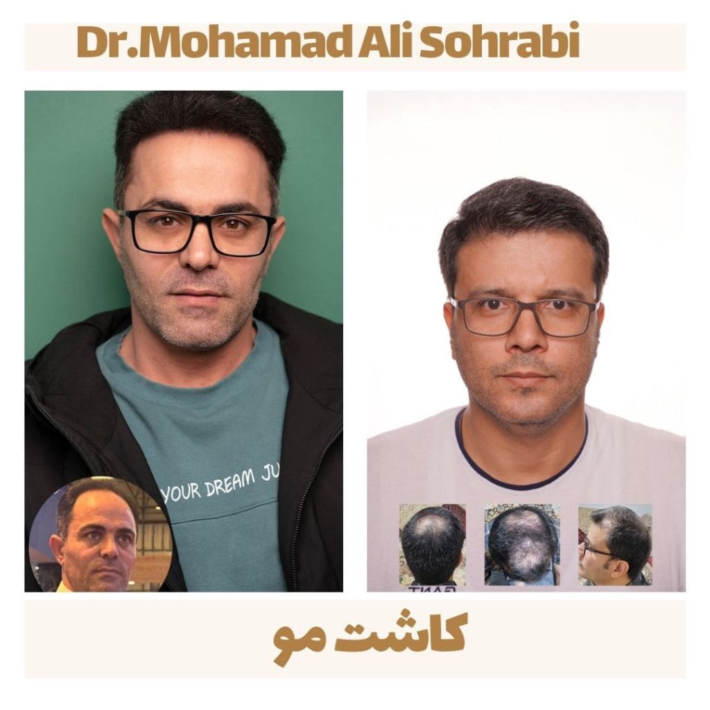 کاشت مو
