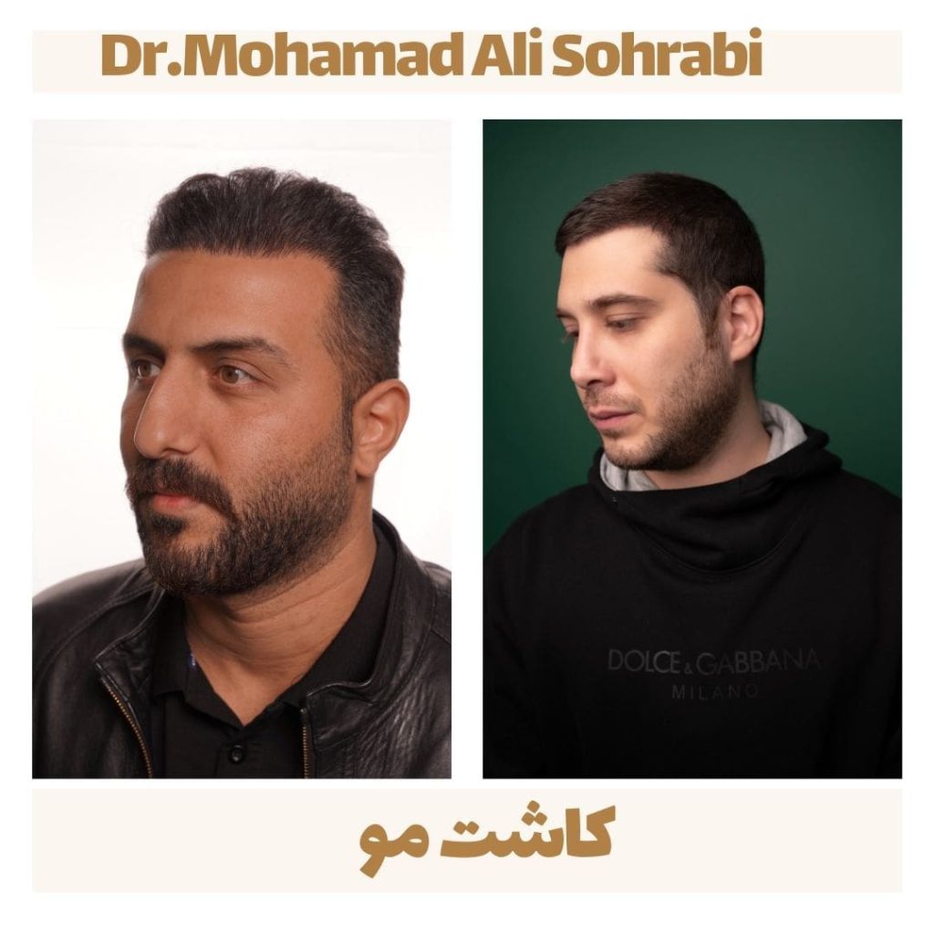 زراعة الشعر