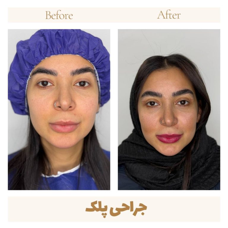 Eyelid surgery