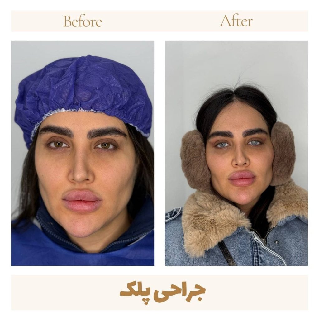 Eyelid surgery