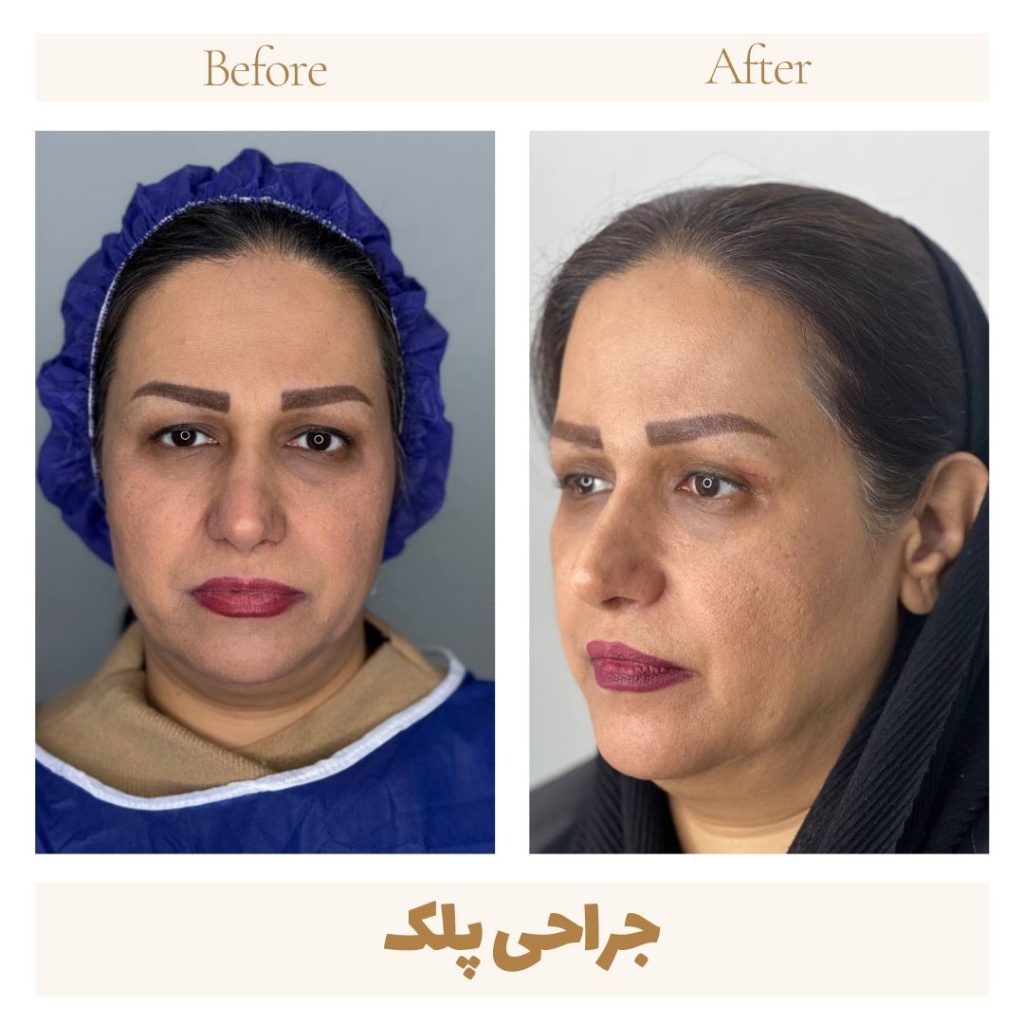 Eyelid surgery