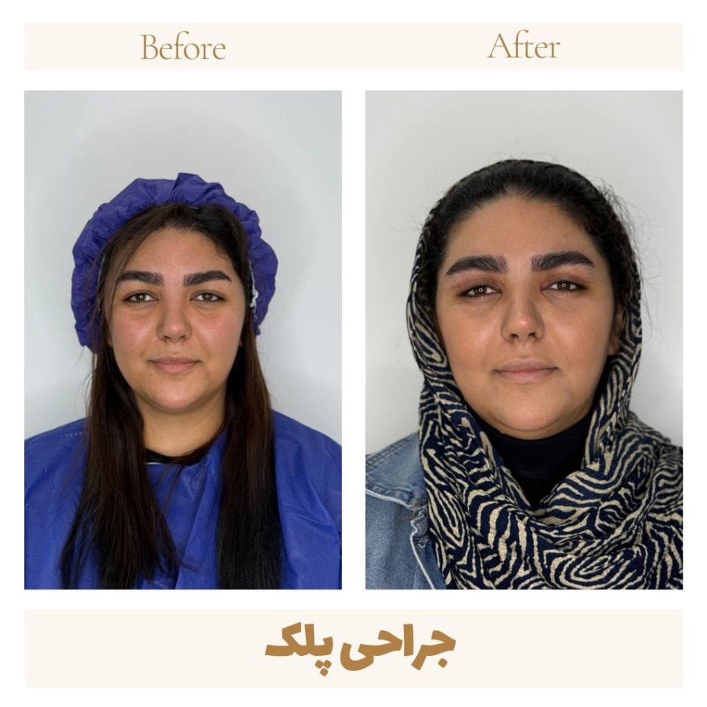 Eyelid surgery