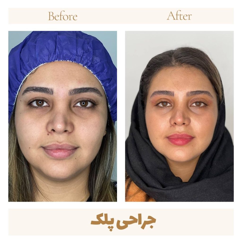Eyelid surgery