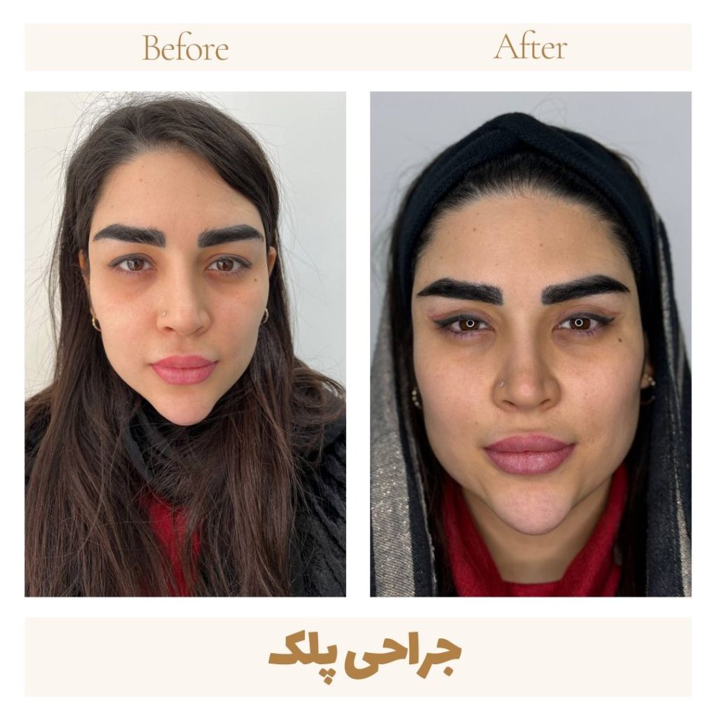 Eyelid surgery