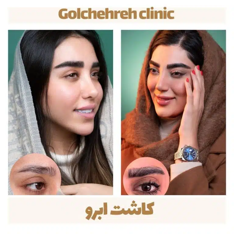 کلینیک گلچهره کاشت ابرو