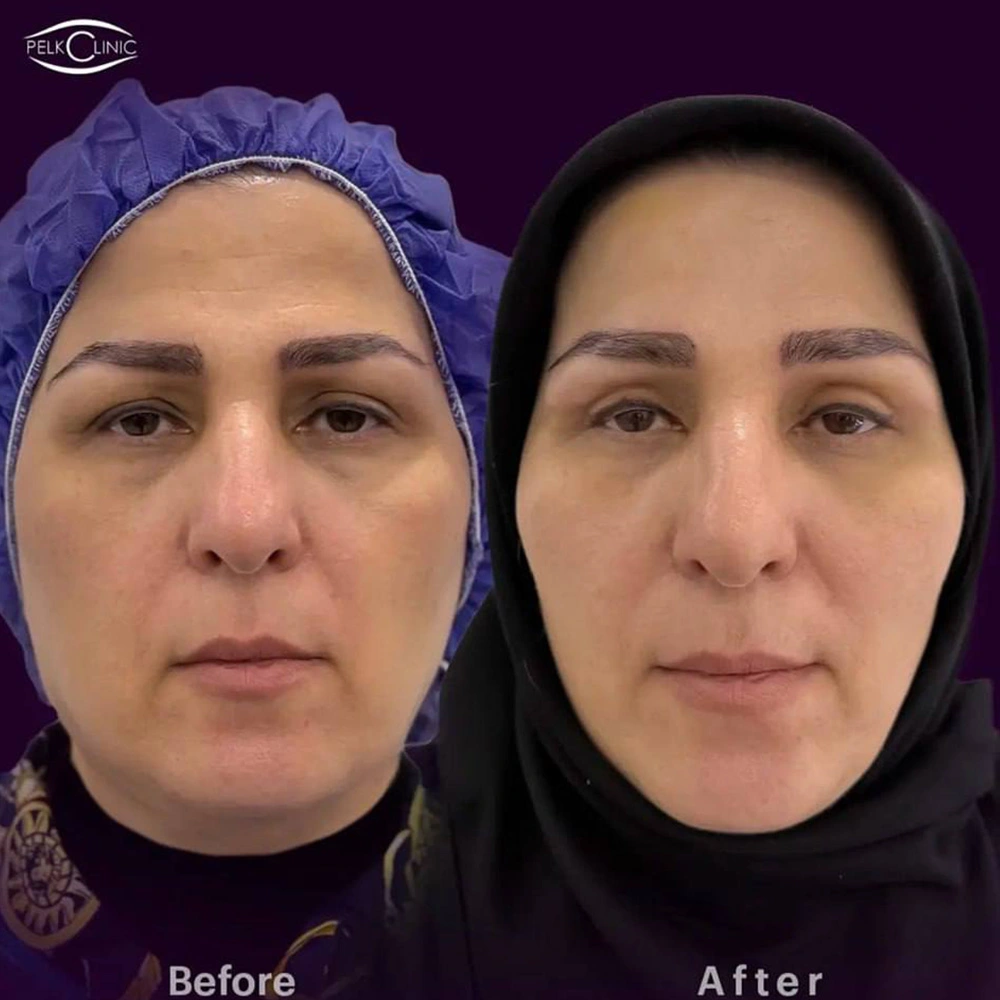 جراحی پلک (بلفاروپلاستی)