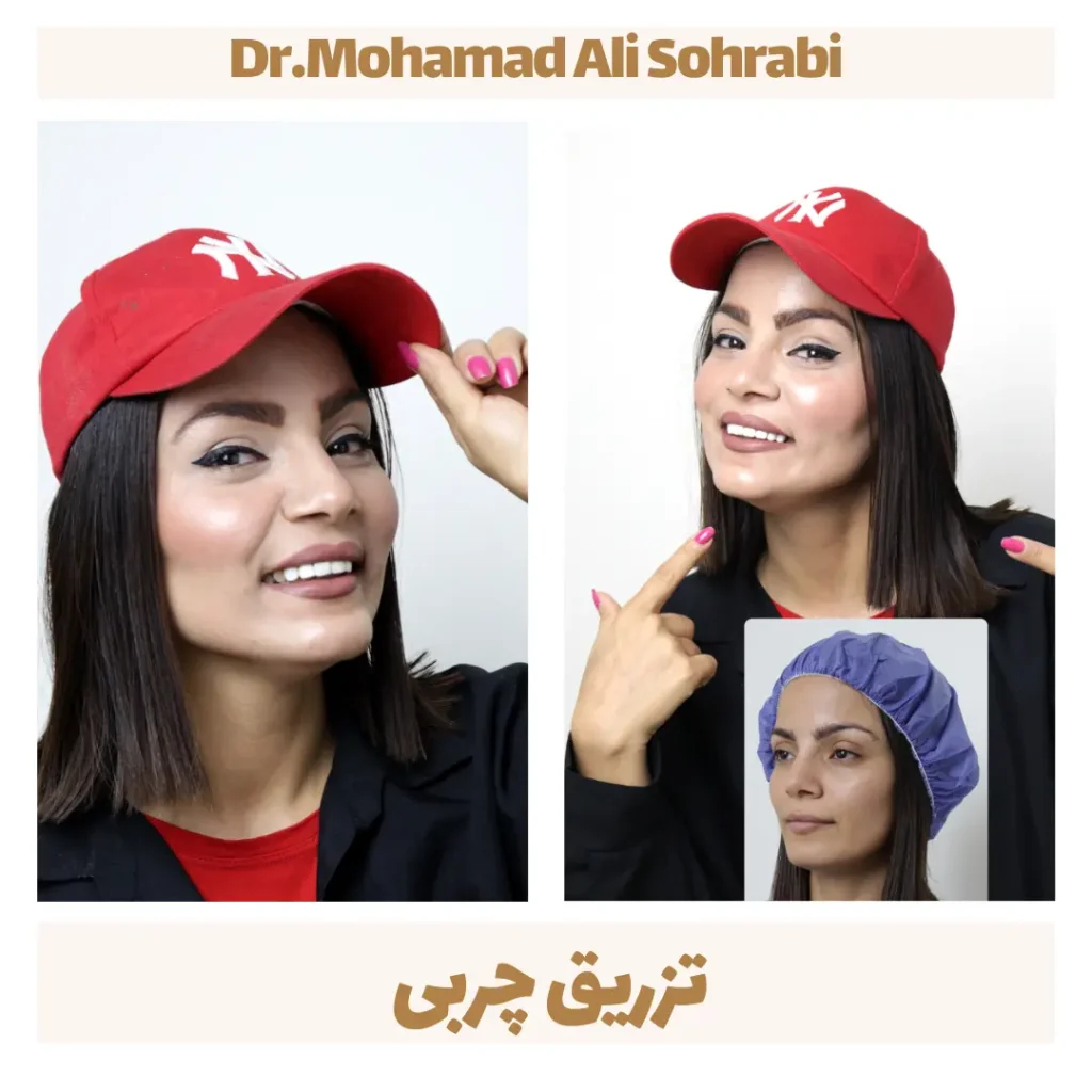 حقن الدهون