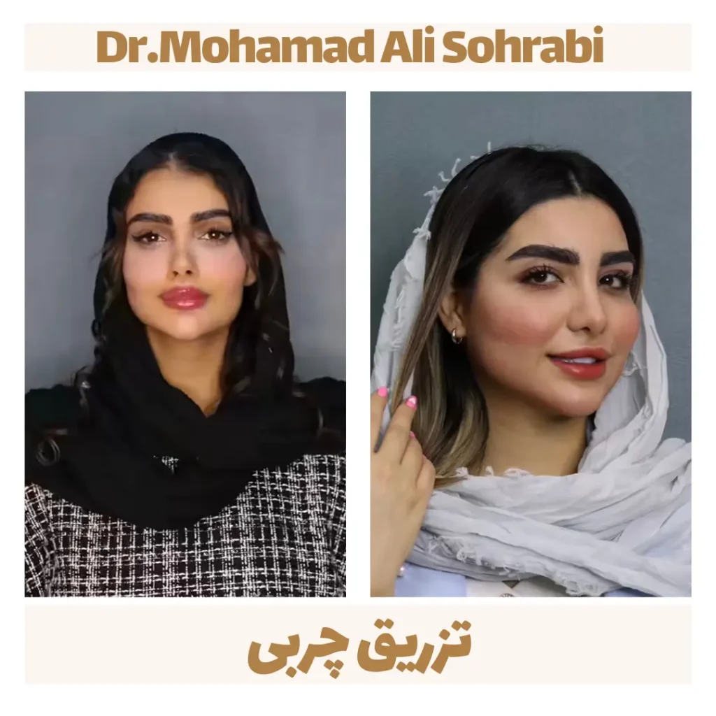 حقن الدهون