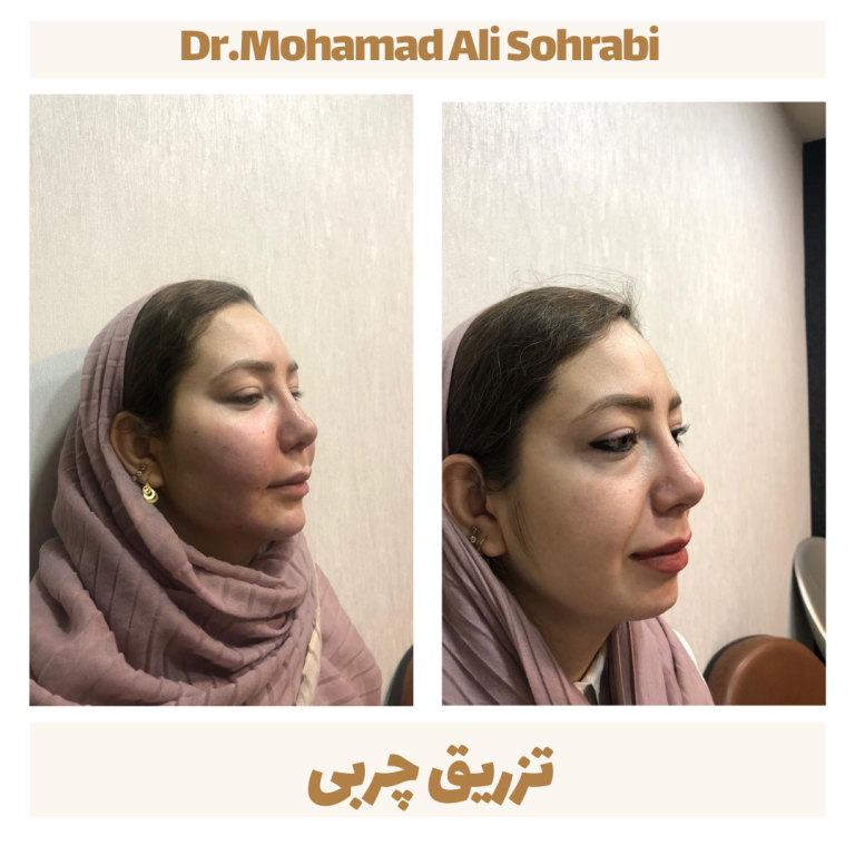 تزریق چربی