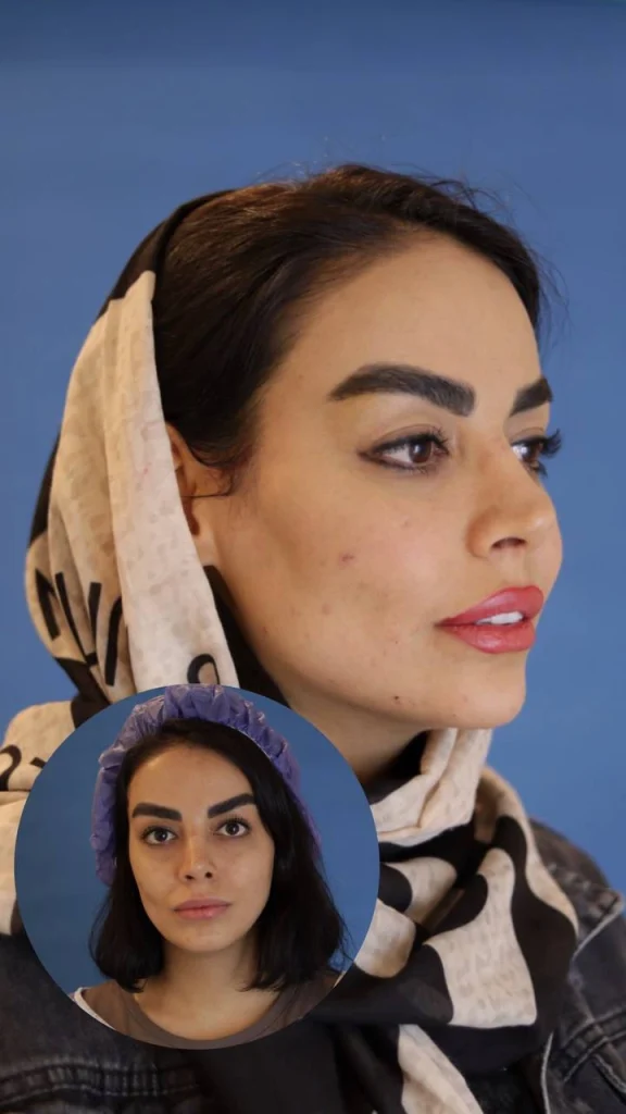 حقن الدهون