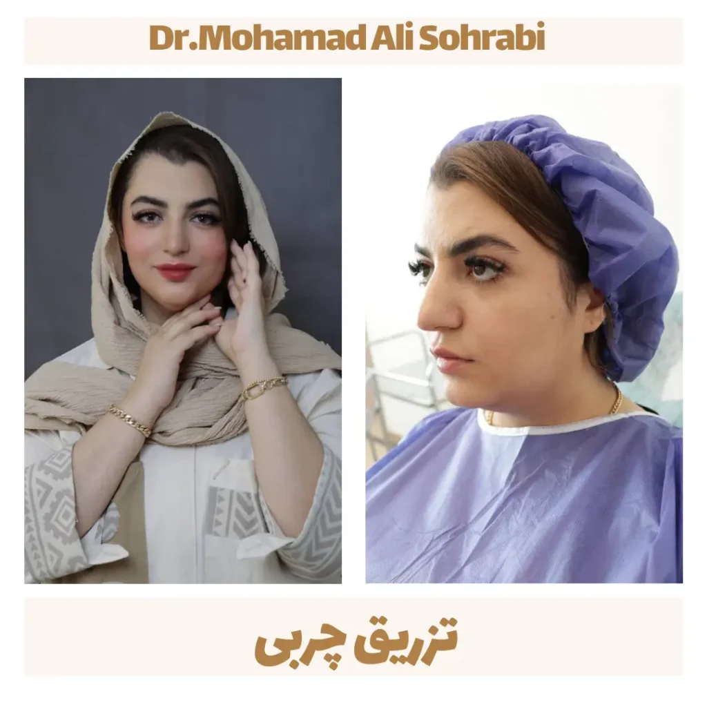 تزریق چربی