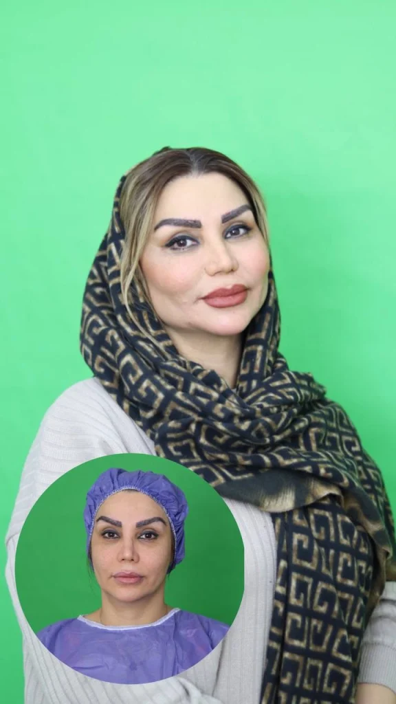 حقن الدهون