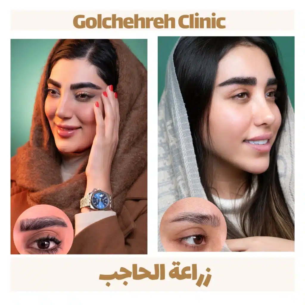 زراعة الحاجب