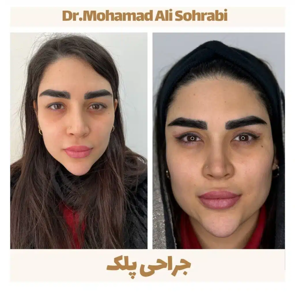 جراحی پلک