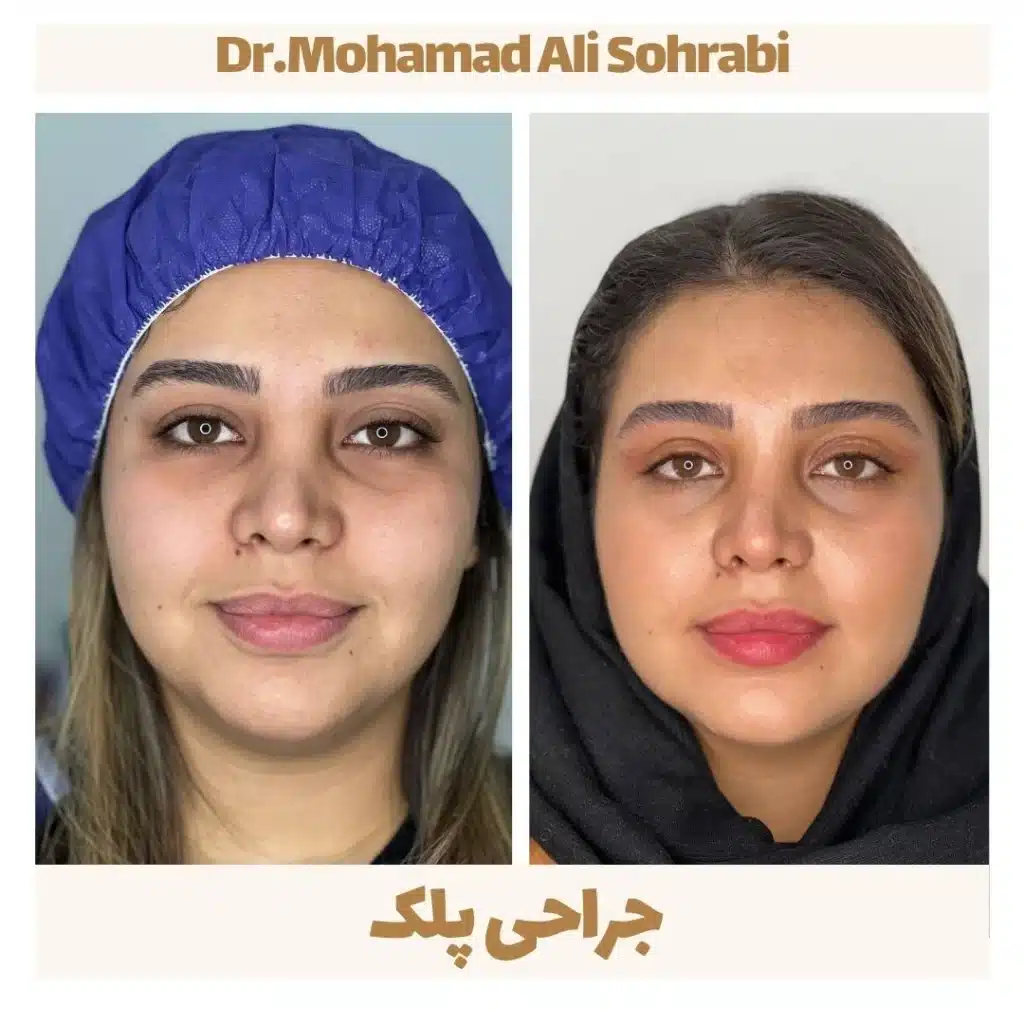 جراحی پلک
