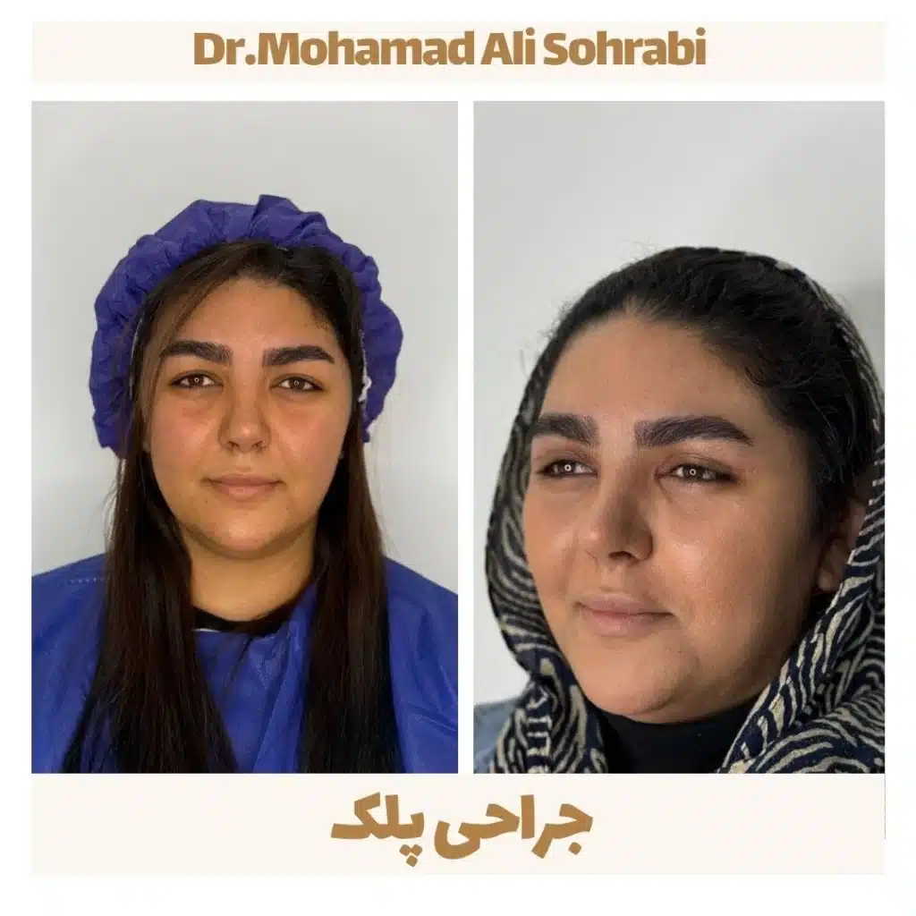 جراحی پلک