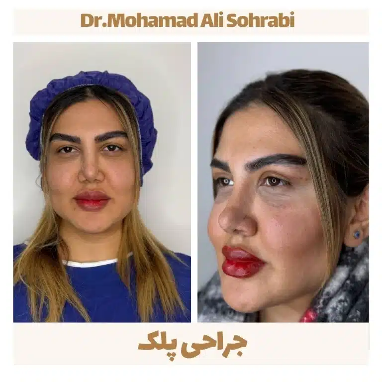 جراحی پلک