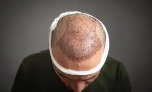کاشت مو