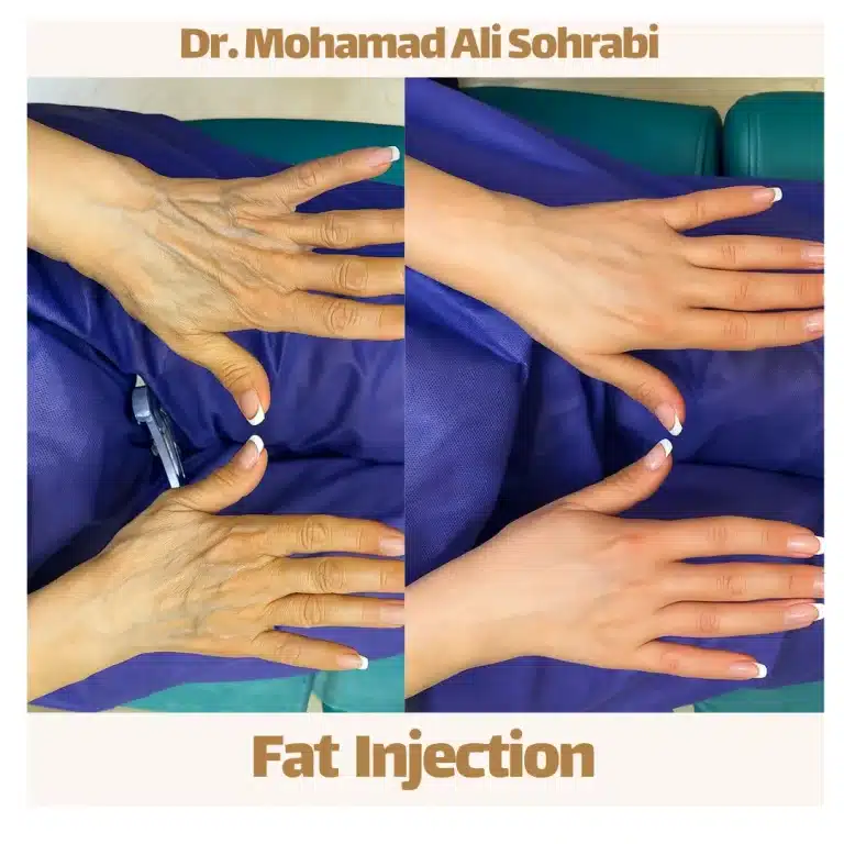 fat injection