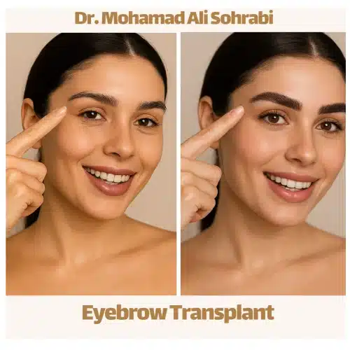 زراعة الحاجب