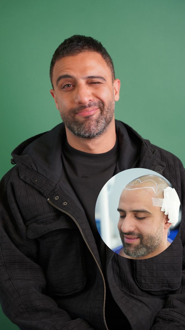 زراعة الشعر