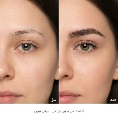 کاشت ابرو بدون جراحی