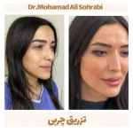 تزریق چربی 7 تزریق چربی 2