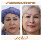 تزریق چربی 12 تزریق چربی۲